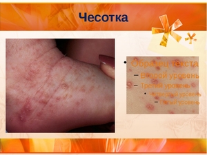Чесотка у человека